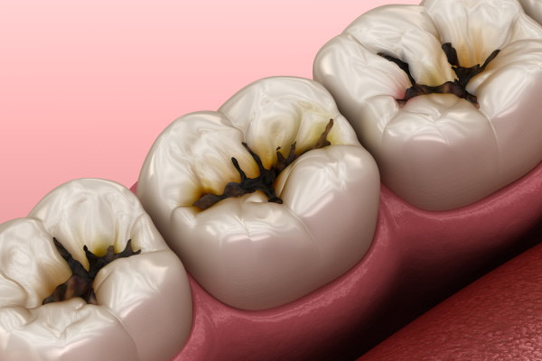 Molar teeth damaged by caries. Medically accurate tooth 3D illustration.